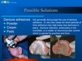 Possible Solutions Denture adhesives Powder Cream  Pads We generally discourage the use of denture adhesive.  In very few cases for short periods of time adhesive may help keep new dentures in place.  Denture retention, particularly in the mandible, is a matter of neuromuscular control which is gained by practice and time. 