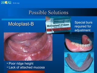 Moloplast-B Poor ridge height Lack of attached mucosa Special burs  required for  adjustment Possible Solutions 