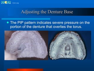 The PIP pattern indicates severe pressure on the portion of the denture that overlies the torus. Adjusting the Denture Base 