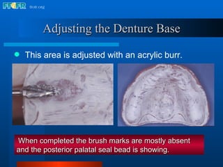 This area is adjusted with an acrylic burr.  When completed the brush marks are mostly absent and the posterior palatal seal bead is showing. Adjusting the Denture Base 