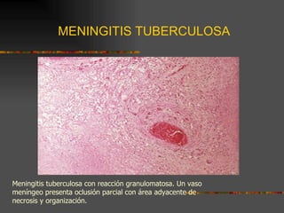 MENINGITIS TUBERCULOSA Meningitis tuberculosa con reacción granulomatosa. Un vaso meníngeo presenta oclusión parcial con área adyacente de necrosis y organización. 
