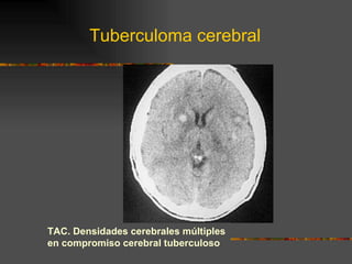 Tuberculoma cerebral TAC. Densidades cerebrales múltiples en compromiso cerebral tuberculoso 