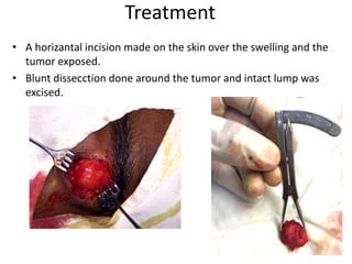 Treatment
• A horizantal incision made on the skin over the swelling and the
tumor exposed.
• Blunt dissecction done around the tumor and intact lump was
excised.
 