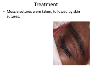 Treatment
• Muscle sutures were taken, followed by skin
sutures.
 