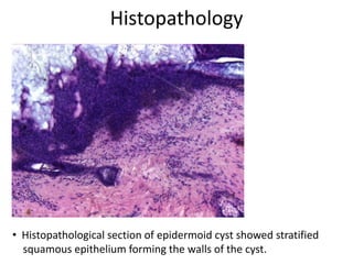 Histopathology
• Histopathological section of epidermoid cyst showed stratified
squamous epithelium forming the walls of the cyst.
 