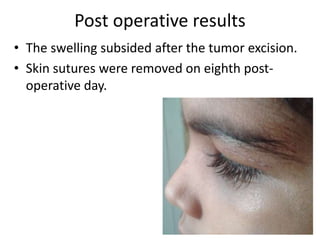 Post operative results
• The swelling subsided after the tumor excision.
• Skin sutures were removed on eighth post-
operative day.
 