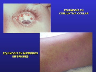 EQUÍMOSIS EN
                        CONJUNTIVA OCULAR




EQUÍMOSIS EN MIEMBROS
     INFERIORES
 