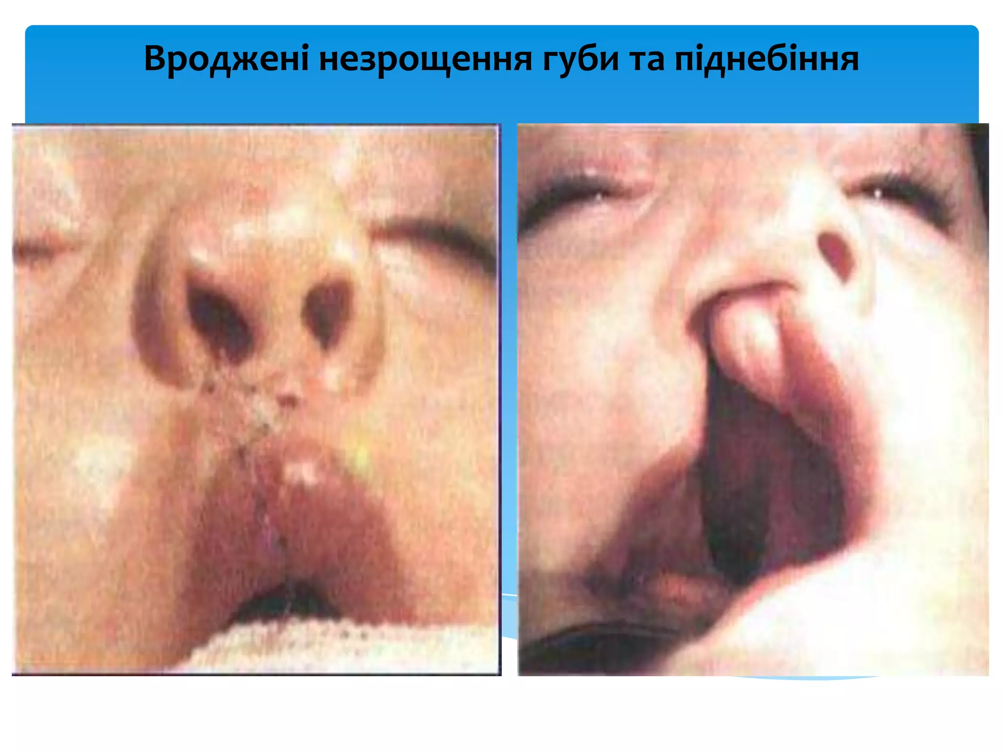 Вроджені незрощення губи та піднебіння
 