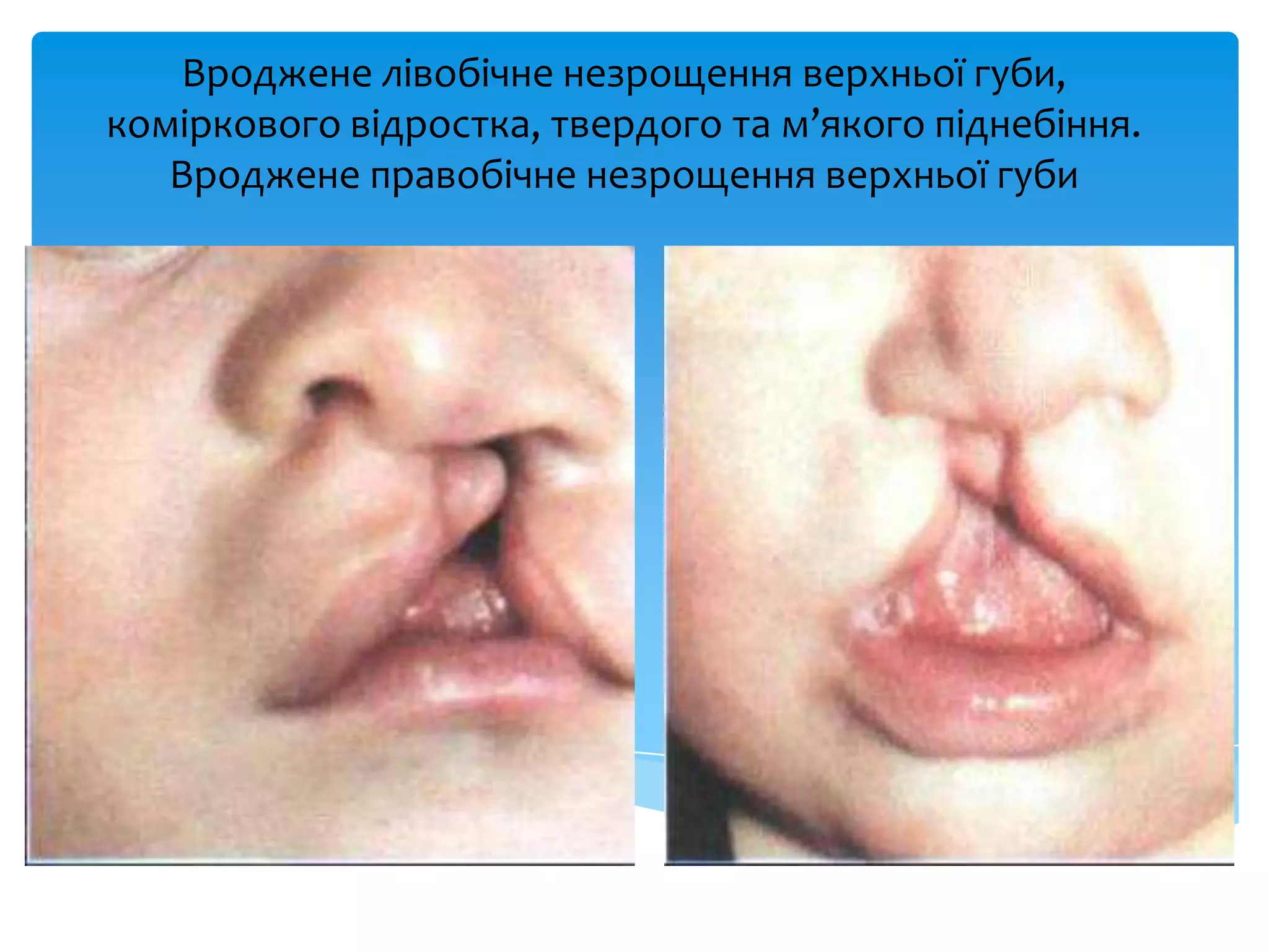 Вроджене лівобічне незрощення верхньої губи,
коміркового відростка, твердого та м’якого піднебіння.
Вроджене правобічне незрощення верхньої губи
 