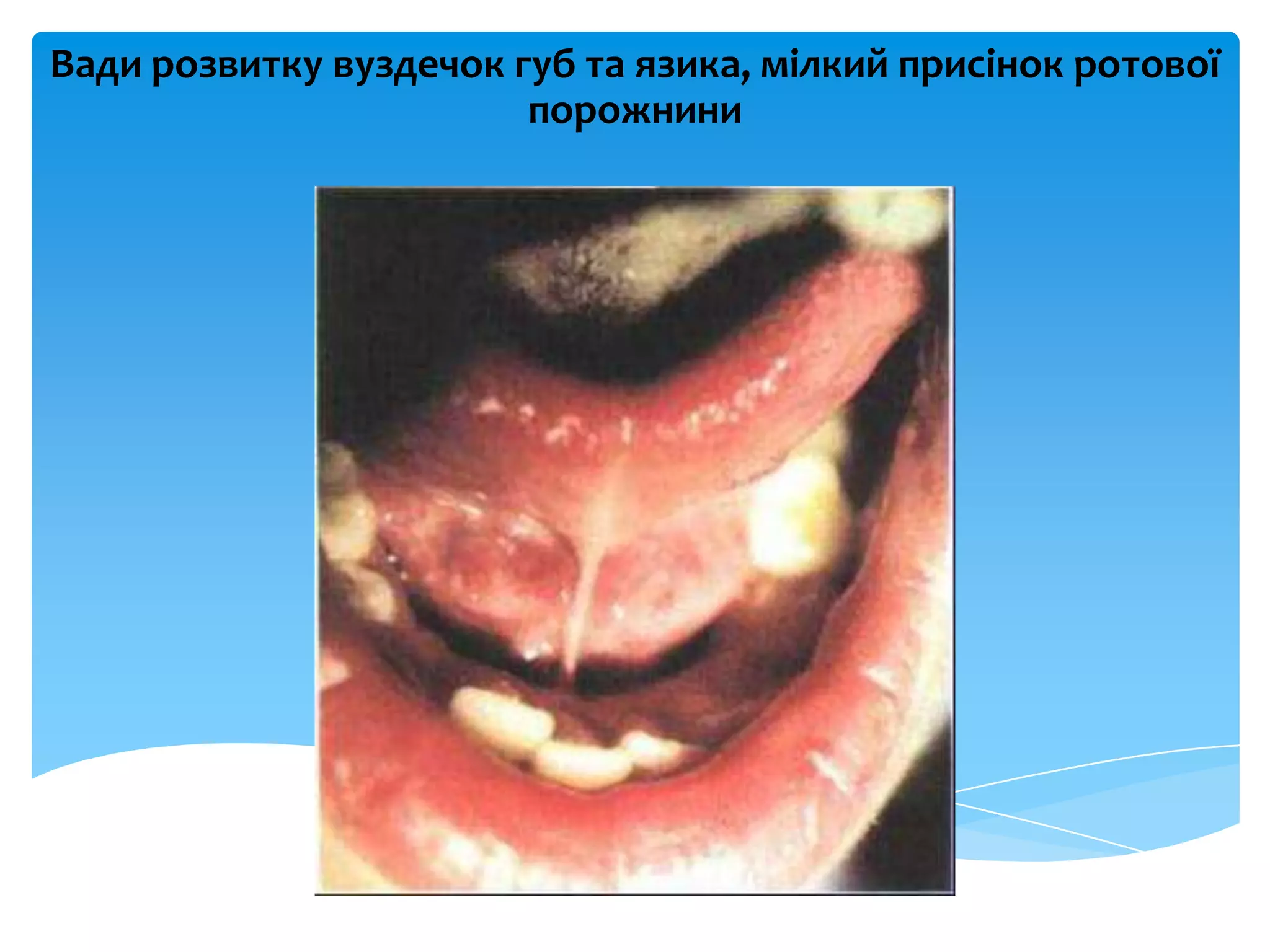 Вади розвитку вуздечок губ та язика, мілкий присінок ротової
порожнини
 