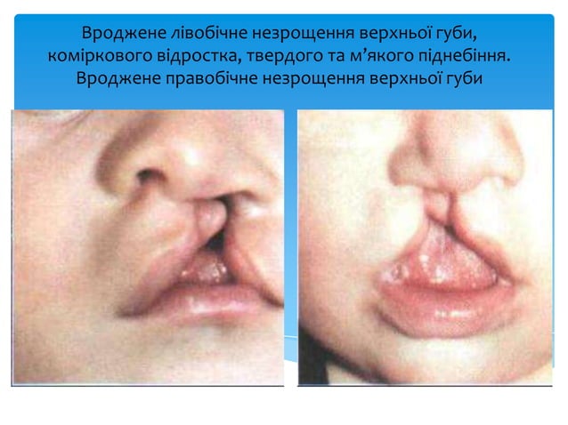 ринолалія