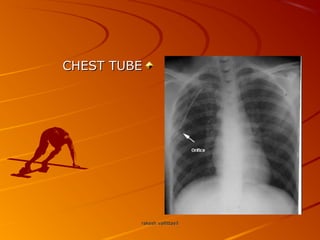 CHEST TUBECHEST TUBE
rakesh vallittayilrakesh vallittayil
 