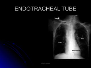ENDOTRACHEAL TUBEENDOTRACHEAL TUBE
rakesh vallittayilrakesh vallittayil
 