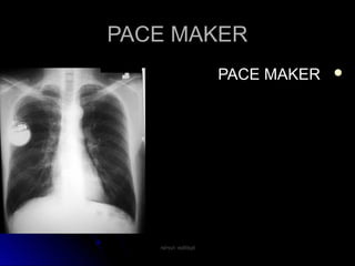 PACE MAKERPACE MAKER
PACE MAKERPACE MAKER
rakesh vallittayilrakesh vallittayil
 