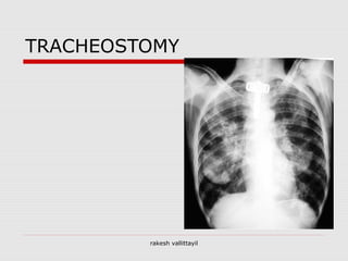 TRACHEOSTOMY
rakesh vallittayil
 