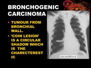 BRONCHOGENIC
CARCINOMA
• TUMOUR FROM
BRONCHIAL
WALL.
• ‘COIN LESION’
IS A CIRCULAR
SHADOW WHICH
IS THE
CHARECTEREST
IC
rakesh vallittayil
 