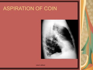 ASPIRATION OF COIN
rakesh vallittayil
 