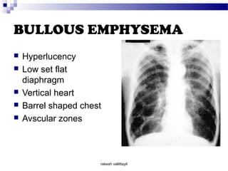 BULLOUS EMPHYSEMA
 Hyperlucency
 Low set flat
diaphragm
 Vertical heart
 Barrel shaped chest
 Avscular zones
rakesh vallittayil
 