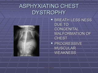 ASPHYXIATING CHESTASPHYXIATING CHEST
DYSTROPHYDYSTROPHY
 BREATH LESS NESSBREATH LESS NESS
DUE TODUE TO
CONGENITALCONGENITAL
MALFORMATION OFMALFORMATION OF
CHESTCHEST
 PROGRESSIVEPROGRESSIVE
MUSCULARMUSCULAR
WEAKNESSWEAKNESS
rakesh vallittayilrakesh vallittayil
 