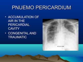 PNUEMO PERICARDIUMPNUEMO PERICARDIUM
• ACCUMULATION OF
AIR IN THE
PERICARDIAL
CAVITY
• CONGENITAL AND
TRAUMATIC
rakesh vallittayilrakesh vallittayil
 