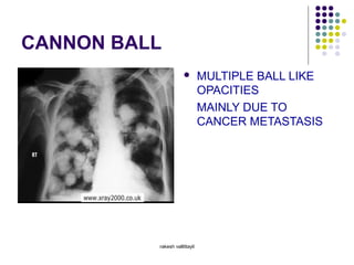 CANNON BALL
 MULTIPLE BALL LIKE
OPACITIES
MAINLY DUE TO
CANCER METASTASIS
rakesh vallittayil
 