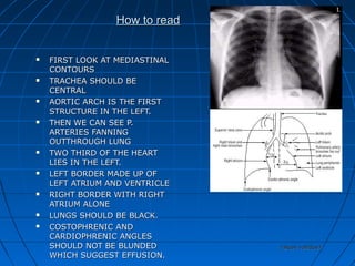 How to readHow to read
 FIRST LOOK AT MEDIASTINALFIRST LOOK AT MEDIASTINAL
CONTOURSCONTOURS
 TRACHEA SHOULD BETRACHEA SHOULD BE
CENTRALCENTRAL
 AORTIC ARCH IS THE FIRSTAORTIC ARCH IS THE FIRST
STRUCTURE IN THE LEFT.STRUCTURE IN THE LEFT.
 THEN WE CAN SEE P.THEN WE CAN SEE P.
ARTERIES FANNINGARTERIES FANNING
OUTTHROUGH LUNGOUTTHROUGH LUNG
 TWO THIRD OF THE HEARTTWO THIRD OF THE HEART
LIES IN THE LEFT.LIES IN THE LEFT.
 LEFT BORDER MADE UP OFLEFT BORDER MADE UP OF
LEFT ATRIUM AND VENTRICLELEFT ATRIUM AND VENTRICLE
 RIGHT BORDER WITH RIGHTRIGHT BORDER WITH RIGHT
ATRIUM ALONEATRIUM ALONE
 LUNGS SHOULD BE BLACK.LUNGS SHOULD BE BLACK.
 COSTOPHRENIC ANDCOSTOPHRENIC AND
CARDIOPHRENIC ANGLESCARDIOPHRENIC ANGLES
SHOULD NOT BE BLUNDEDSHOULD NOT BE BLUNDED
WHICH SUGGEST EFFUSION.WHICH SUGGEST EFFUSION.
rakesh vallittayilrakesh vallittayil
 