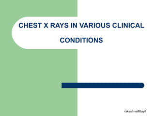 CHEST X RAYS IN VARIOUS CLINICAL
CONDITIONS
rakesh vallittayil
 