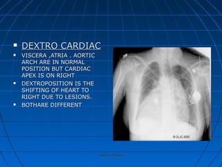  DEXTRO CARDIACDEXTRO CARDIAC
 VISCERA ,ATRIA . AORTICVISCERA ,ATRIA . AORTIC
ARCH ARE IN NORMALARCH ARE IN NORMAL
POSITION BUT CARDIACPOSITION BUT CARDIAC
APEX IS ON RIGHTAPEX IS ON RIGHT
 DEXTROPOSITION IS THEDEXTROPOSITION IS THE
SHIFTING OF HEART TOSHIFTING OF HEART TO
RIGHT DUE TO LESIONS.RIGHT DUE TO LESIONS.
 BOTHARE DIFFERENTBOTHARE DIFFERENT
rakesh vallittayilrakesh vallittayil
 