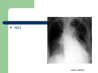  NGT
rakesh vallittayil
 