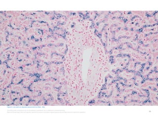 39
This field guide is intended to be an educational supplement, not a substitute for product labeling.
Refer to the package insert and operator manual for primary information regarding your special stains kits and instrument operation.
Figure 5. Liver with iron deposits stained with Iron Stain , 200x.
 