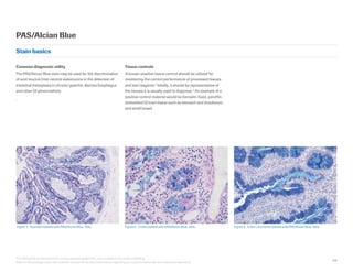 54
This field guide is intended to be an educational supplement, not a substitute for product labeling.
Refer to the package insert and operator manual for primary information regarding your special stains kits and instrument operation.
Figure 3.  Stomach stained with PAS/Alcian Blue, 100x. Figure 4.  Colon stained with PAS/Alcian Blue, 400x. Figure 5.  Colon carcinoma stained with PAS/Alcian Blue, 200x.
Common diagnostic utility
The PAS/Alcian Blue stain may be used for the discrimination
of acid mucins from neutral sialomucins in the detection of
intestinal metaplasia in chronic gastritis, Barrets Esophagus
and other GI abnormalities.
.
Tissue controls
A known positive tissue control should be utilized for
monitoring the correct performance of processed tissues
and test reagents.4
Ideally, it should be representative of
the tissues it is usually used to diagnose.3
An example of a
positive control material would be formalin-fixed, paraffin-
embedded GI tract tissue such as stomach and duodenum,
and small bowel.
PAS/Alcian Blue
Stain basics
 