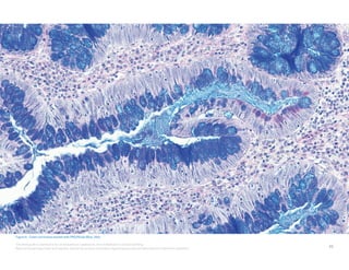 55
This field guide is intended to be an educational supplement, not a substitute for product labeling.
Refer to the package insert and operator manual for primary information regarding your special stains kits and instrument operation.
Figure 6.  Colon carcinoma stained with PAS/Alcian Blue, 200x.
 