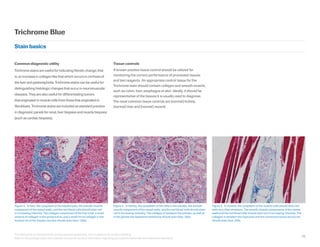 70
This field guide is intended to be an educational supplement, not a substitute for product labeling.
Refer to the package insert and operator manual for primary information regarding your special stains kits and instrument operation.
Figure 3.  In liver, the cytoplasm of the hepatocytes, the smooth muscle
component of the vessel walls, and the red blood cells should stain red
in increasing intensity. The collagen component of the liver triad, a small
amount of collagen in the portal tracts, and a small rim of collagen in the
luminal rim of the hepatic venules should stain blue.2
200x.
Figure 4.  In kidney, the cytoplasm of the cells in the tubules, the smooth
muscle component of the vessel walls, and the red blood cells should stain
red in increasing intensity. The collagen in between the tubules, as well as
in the glomerular basement membrane should stain blue. 200x.
Figure 5.  In muscle, the cytoplasm of the muscle cells should stain red
with very clear striations. The smooth muscle components of the vessel
walls and the red blood cells should stain red in increasing intensity. The
collagen in between the myocytes and the connective tissue structures
should stain blue. 200x.
Common diagnostic utility
Trichrome stains are useful for indicating fibrotic change; that
is, an increase in collagen like that which occurs in cirrhosis of
the liver and pyelonephritis. Trichrome stains can be useful for
distinguishing histologic changes that occur in neuromuscular
diseases. They are also useful for differentiating tumors
that originated in muscle cells from those that originated in
fibroblasts. Trichrome stains are included as standard practice
in diagnostic panels for renal, liver biopsies and muscle biopsies
(such as cardiac biopsies).
Tissue controls
A known positive tissue control should be utilized for
monitoring the correct performance of processed tissues
and test reagents. An appropriate control tissue for the
Trichrome stain should contain collagen and smooth muscle,
such as colon, liver, esophagus or skin. Ideally, it should be
representative of the tissues it is usually used to diagnose.
The most common tissue controls are (normal) kidney,
(normal) liver and (normal) muscle.
Trichrome Blue
Stain basics
 