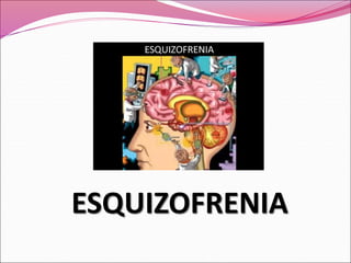 ESQUIZOFRENIA
 