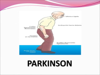 PARKINSON
 