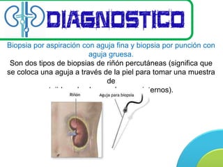 Biopsia Riñon Cancer Renal | PPTX