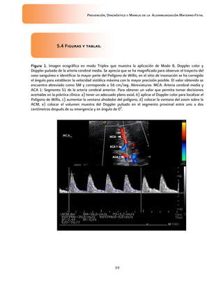 Prevención, Diagnóstico y Manejo de la Aloinmunización Materno-Fetal
39
5.5.5.5.4444 Figuras y tablas.Figuras y tablas.Figuras y tablas.Figuras y tablas.
FiguraFiguraFiguraFigura 1111. Imagen ecográfica en modo Triplex que muestra la aplicación de Modo B, Doppler color y
Doppler pulsado de la arteria cerebral media. Se aprecia que se ha magnificado para observar el trayecto del
vaso sanguíneo e identificar la mayor parte del Polígono de Willis; en el sitio de insonación se ha corregido
el ángulo para establecer la velocidad sistólica máxima con la mayor precisión posible. El valor obtenido se
encuentra abreviado como SM y corresponde a 56 cm/seg. Abreviaturas: MCA: Arteria cerebral media y
ACA 1: Segmento S1 de la arteria cerebral anterior. Para obtener un valor que permita tomar decisiones
acertadas en la práctica clínica: a) tener un adecuado plano axial, b) aplicar el Doppler color para localizar el
Polígono de Willis, c) aumentar la ventana alrededor del polígono, d) colocar la ventana del zoom sobre la
ACM, e) colocar el volumen muestra del Doppler pulsado en el segmento proximal entre uno a dos
centímetros después de su emergencia y en ángulo de 00
.
 
