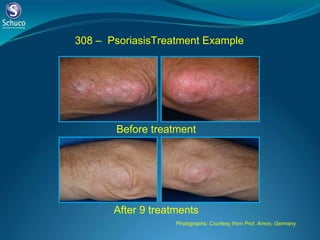 Photographs: Courtesy from Prof. Amon, Germany 308 –  Psoriasis Treatment Example Before treatment  After 9 treatments  