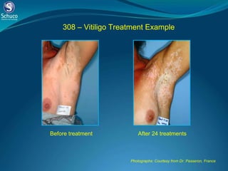 308 – Vitiligo Treatment Example Before treatment After 24 treatments Photographs: Courtesy from Dr. Passeron, France 