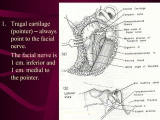 1. Tragal cartilage
(pointer) – always
point to the facial
nerve.
The facial nerve is
1 cm. inferior and
1 cm. medial to
the pointer.
sumeryadav2004@gmail.com
 