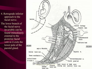 4. Retrograde inferior
approach to the
facial nerve.
The lower branch of
the facial nerve
invariably can be
found immediately
external to the
posterior facial
vein as it exits the
lower pole of the
parotid gland.
sumeryadav2004@gmail.com
 