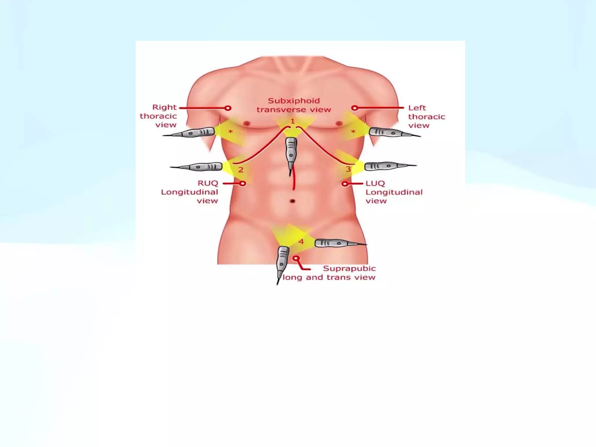 FAST focused assessment with sonography for trauma | PPTX