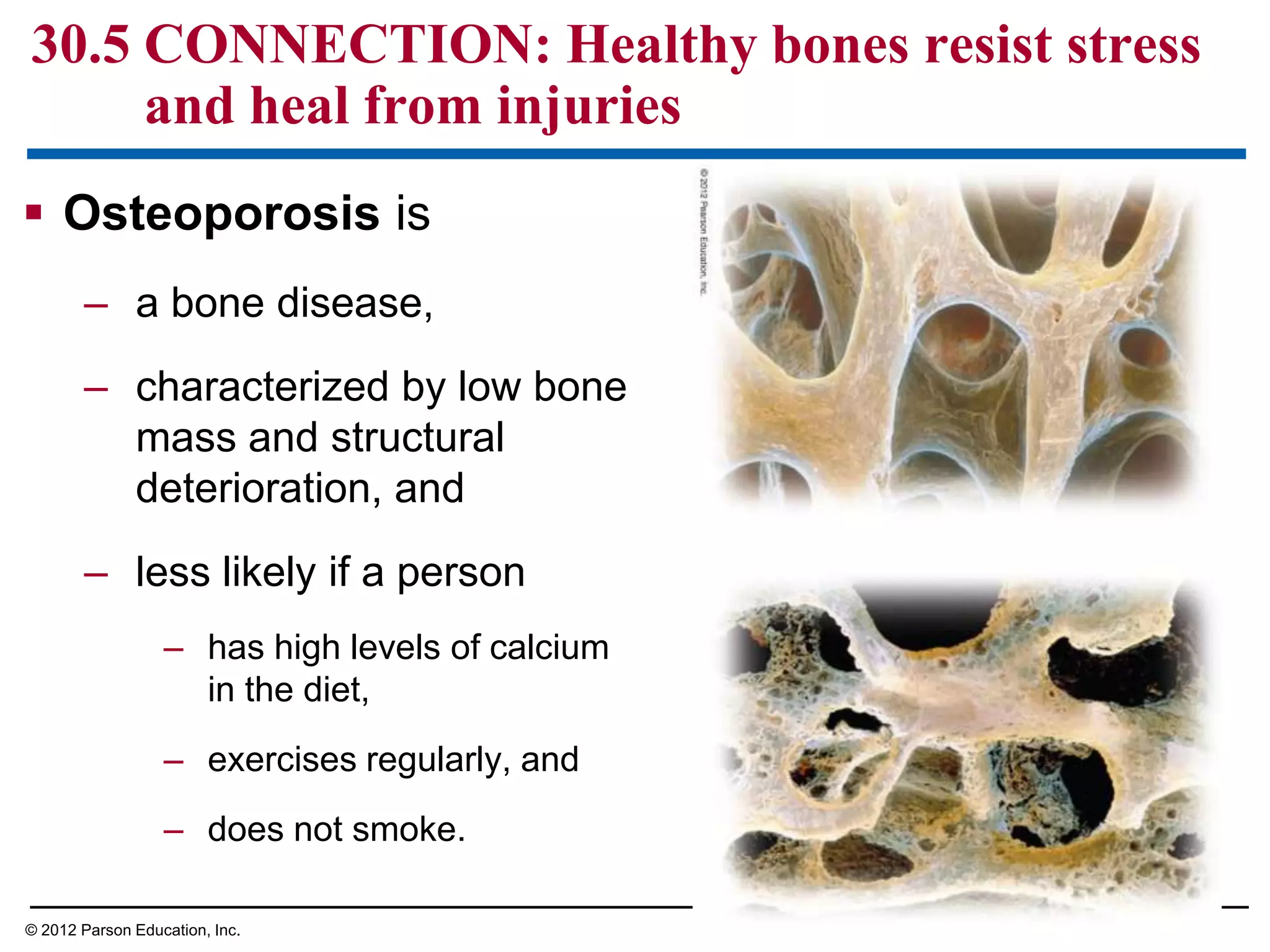  Osteoporosis is
– a bone disease,
– characterized by low bone
mass and structural
deterioration, and
– less likely if a person
– has high levels of calcium
in the diet,
– exercises regularly, and
– does not smoke.
30.5 CONNECTION: Healthy bones resist stress
and heal from injuries
© 2012 Parson Education, Inc.
 