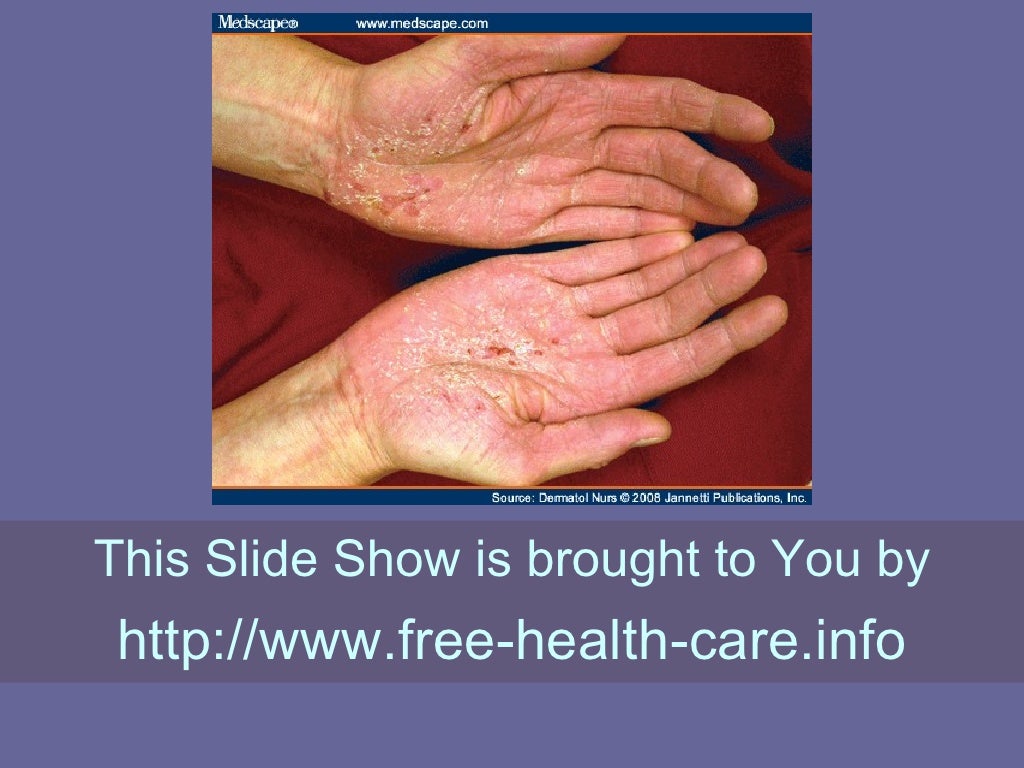 The Facts About Perianal Dermatitis