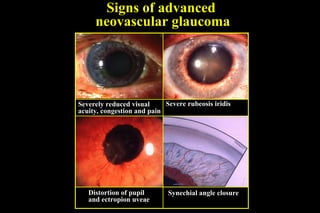 Subtle Rubeosis Comprehensive Overview of Secondary Glaucomas: Types, Signs, and ...