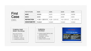 CLINICAL CASE
MLMN – 30 yo female
SURGICAL
TECHNIQUE
First
Case
1991
 CERATECTOMIA PARCIAL COM
MICROCERÁTOMO
 THICKNESS – 0,17mm
 RING IMPLANT
 SPREAD POINTS SUTURE
RING SPECIFICATION:
 Ø OUTER – 4,5 mm
 Ø INNER – 3,5 mm
 THICKNESS – 0,30 mm
 TRIANGULAR SECTION
POST OP DATA 09/91 10/91 02/92 03/94
AVSC 20/200 20/70 20/200 20/200
AVCC 20/25 20/30 20/40 20/50
REFRACTION +1,00 – 1,50 X 10 +1,00 – 1,50 X 10 -4,0 -2,50 X 15 -4,0 -2,50 X 15
KERATOMETRY Inviável inviável inviável inviável
 