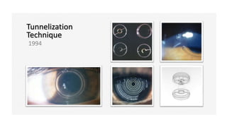 Tunnelization
Technique
1994
 