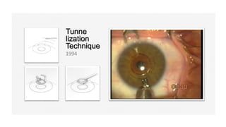 Tunne
lization
Technique
1994
 