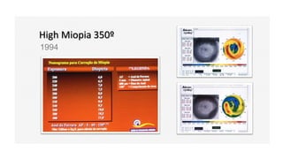 High Miopia 350º
1994
 