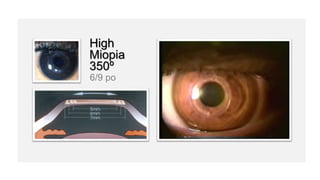 High
Miopia
350º
6/9 po
 